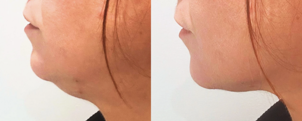 soin double menton réduction sans chirurgie FaceSculpt